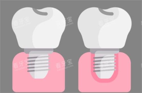 ��ֲ��ǰ��Ա�ͼ