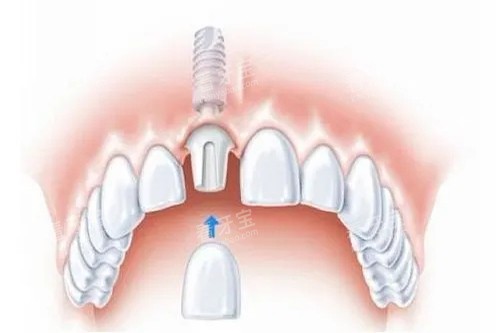 ������ֲ����װ���ڿ�ͨʾ��ͼ