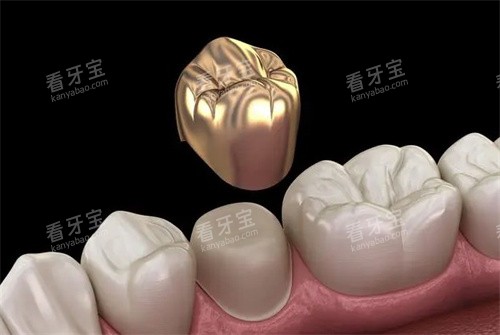 牙冠的材质 牙冠的材质