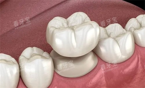 牙冠是怎么做的 牙冠是怎么做的