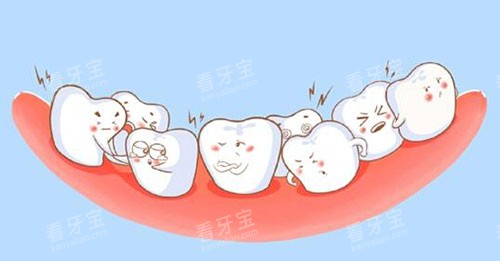 牙齿拥挤漫画示意图 牙齿拥挤漫画示意图