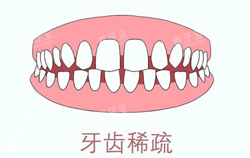 牙齿稀疏卡通示意图 牙齿稀疏卡通示意图