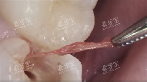抽出牙神经 抽出牙神经