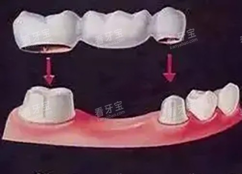 固定桥 固定桥
