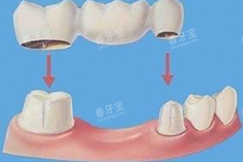 固定桥示意图 固定桥示意图