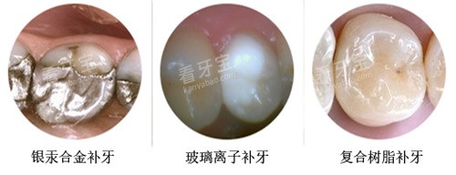 补牙材料示意图 补牙材料示意图