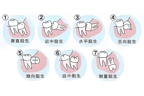 智齿难度系数图 智齿难度系数图