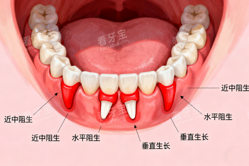 各类型智齿卡通图 各类型智齿卡通图