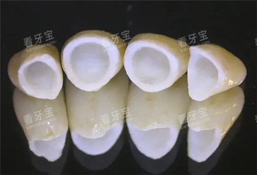 全瓷牙连桥冠照片 全瓷牙连桥冠照片