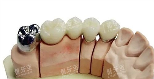 不同种类的烤瓷牙 不同种类的烤瓷牙