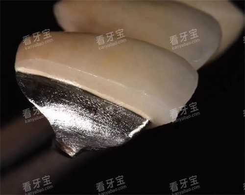 义佳微纳熔覆义齿展示图 义佳微纳熔覆义齿展示图