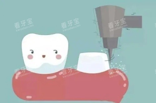牙齿打桩卡通图 牙齿打桩卡通图