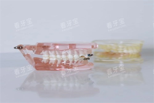 正畸模型图片.jpg 正畸模型图片.jpg