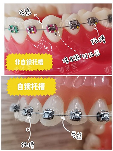 牙齿矫正自锁和非自锁牙套区别.jpg 牙齿矫正自锁和非自锁牙套区别.jpg