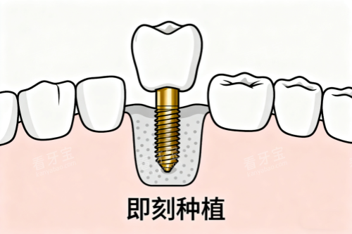牙齿即刻种植卡通图 牙齿即刻种植卡通图