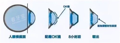 角膜塑形镜8小时后变化.jpg 角膜塑形镜8小时后变化.jpg