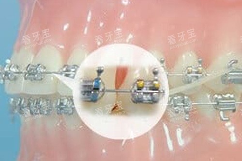 牙齿矫正细节图.jpg 牙齿矫正细节图.jpg