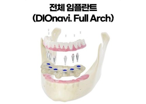 韩国dio种植体半口种植牙.jpg 韩国dio种植体半口种植牙.jpg