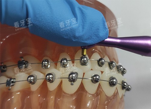 牙齿矫正OBrace球面托槽细节示意图.jpg 牙齿矫正OBrace球面托槽细节示意图.jpg