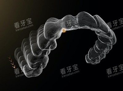 时代天使隐形正畸特色.jpg 时代天使隐形正畸特色.jpg