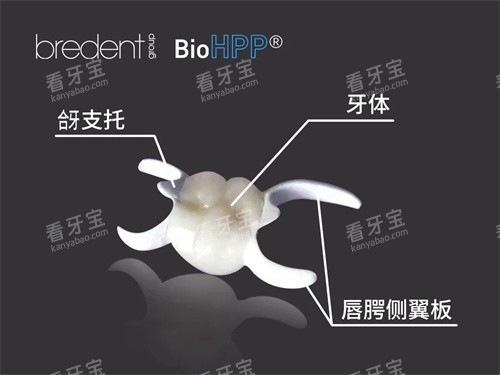 hpp粘接桥结构展示图.jpg hpp粘接桥结构展示图.jpg