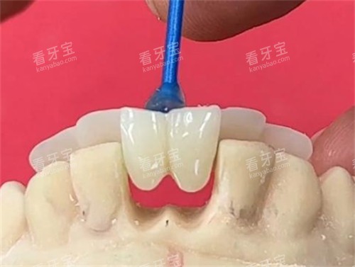马里兰桥修复原理.jpg 马里兰桥修复原理.jpg