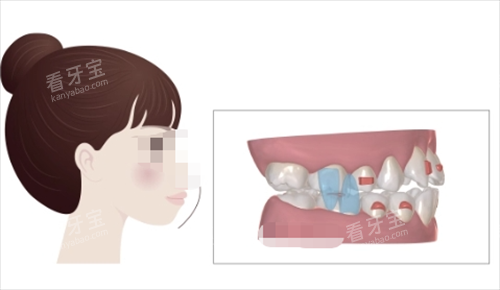 正雅隐形矫正S8突面矫正展示.png 正雅隐形矫正S8突面矫正展示.png