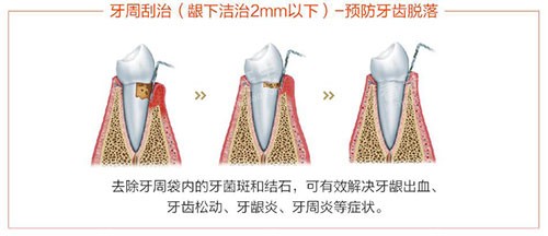 洗牙龈下刮治过程示意图.jpg 洗牙龈下刮治过程示意图.jpg