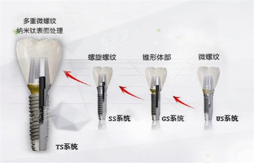 韩国奥齿泰种植体型号.jpg 韩国奥齿泰种植体型号.jpg