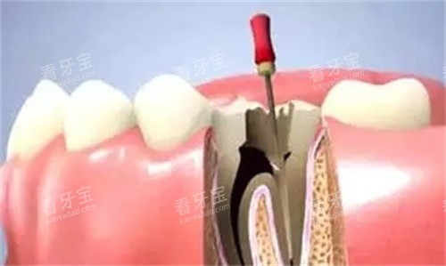 根管治疗动画图.jpg 根管治疗动画图.jpg