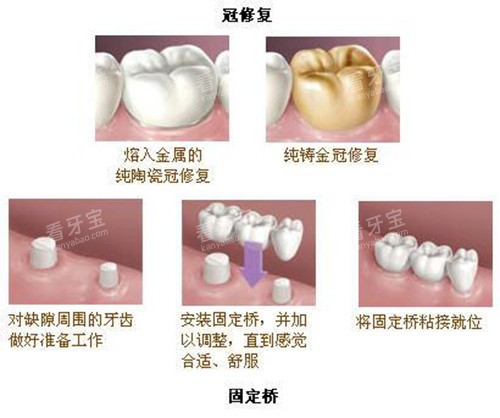牙冠修复及固定桥展示过程.jpg 牙冠修复及固定桥展示过程.jpg