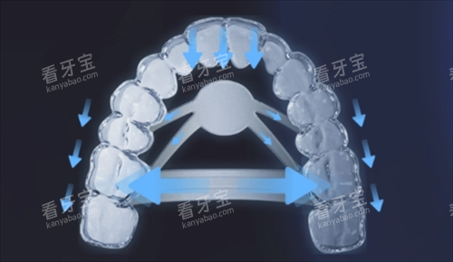 正雅隐形矫正s11牙齿位移变化.png 正雅隐形矫正s11牙齿位移变化.png