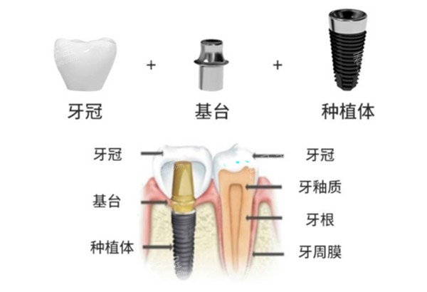 威高种植牙手术过程示意图.jpg 威高种植牙手术过程示意图.jpg
