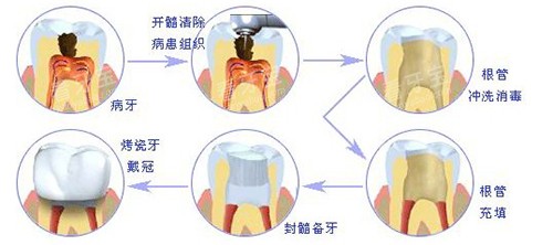 根管治疗过程示意图.jpg 根管治疗过程示意图.jpg