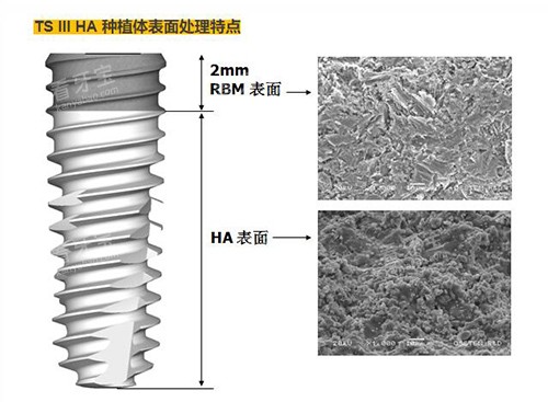 奥齿泰TS3植体材质优势.jpg 奥齿泰TS3植体材质优势.jpg