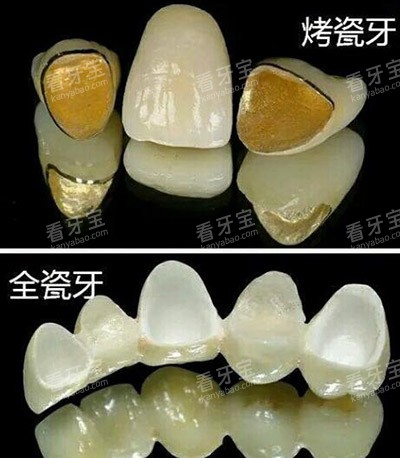 烤瓷牙冠全瓷冠对比.jpg 烤瓷牙冠全瓷冠对比.jpg