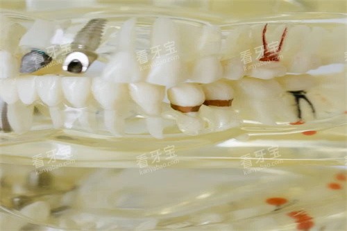 种植牙图展示.jpg 种植牙图展示.jpg