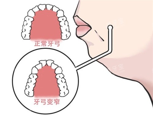 牙齿矫正扩牙弓目的.jpg 牙齿矫正扩牙弓目的.jpg