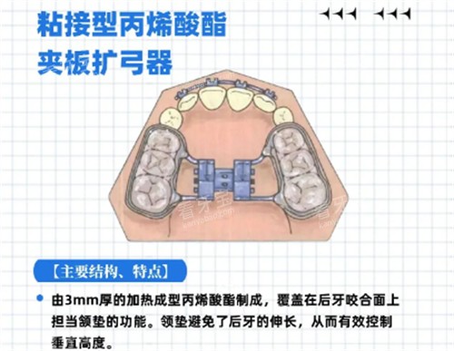 粘接式扩弓器结构特点.jpg 粘接式扩弓器结构特点.jpg