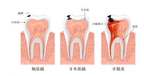 牙髓炎和其他牙齿炎症的对比.png 牙髓炎和其他牙齿炎症的对比.png
