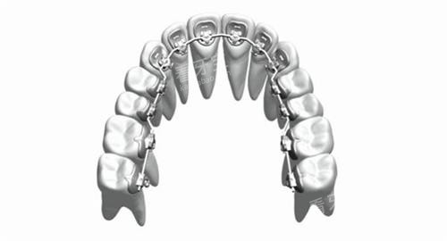 牙齿矫正舌侧矫正牙套概念透视图.jpg 牙齿矫正舌侧矫正牙套概念透视图.jpg