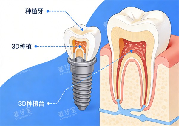 种植牙模型展示示意图.jpg 种植牙模型展示示意图.jpg