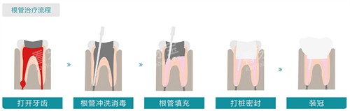 根管治疗流程图展示.jpg 根管治疗流程图展示.jpg