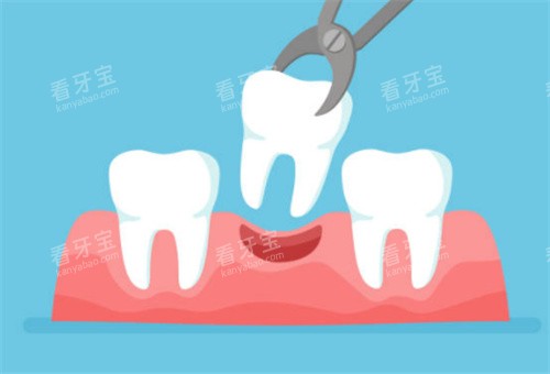 牙齿拔牙示意图.jpg 牙齿拔牙示意图.jpg