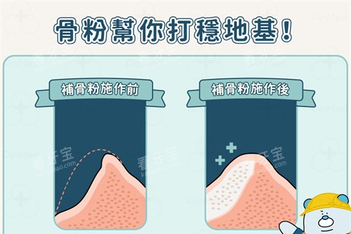 种植牙植骨前后漫画对比图.jpg 种植牙植骨前后漫画对比图.jpg