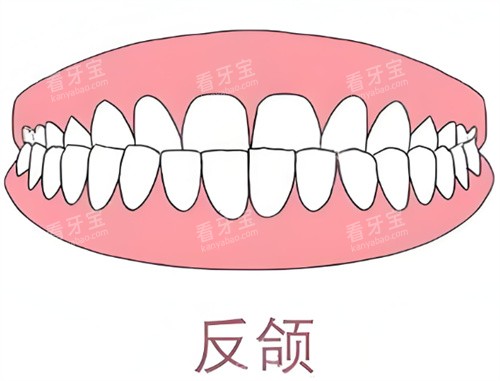牙齿反颌卡通示意图.jpg 牙齿反颌卡通示意图.jpg