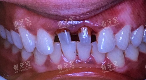 牙齿治疗细节图.jpg 牙齿治疗细节图.jpg