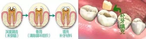 补牙过程展示.jpg 补牙过程展示.jpg