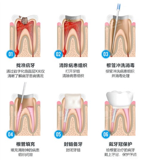 根管治疗流程示意图.jpg 根管治疗流程示意图.jpg
