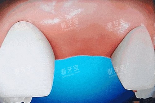 牙齿缺失卡通示意图.jpg 牙齿缺失卡通示意图.jpg
